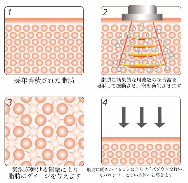 キャビテーション